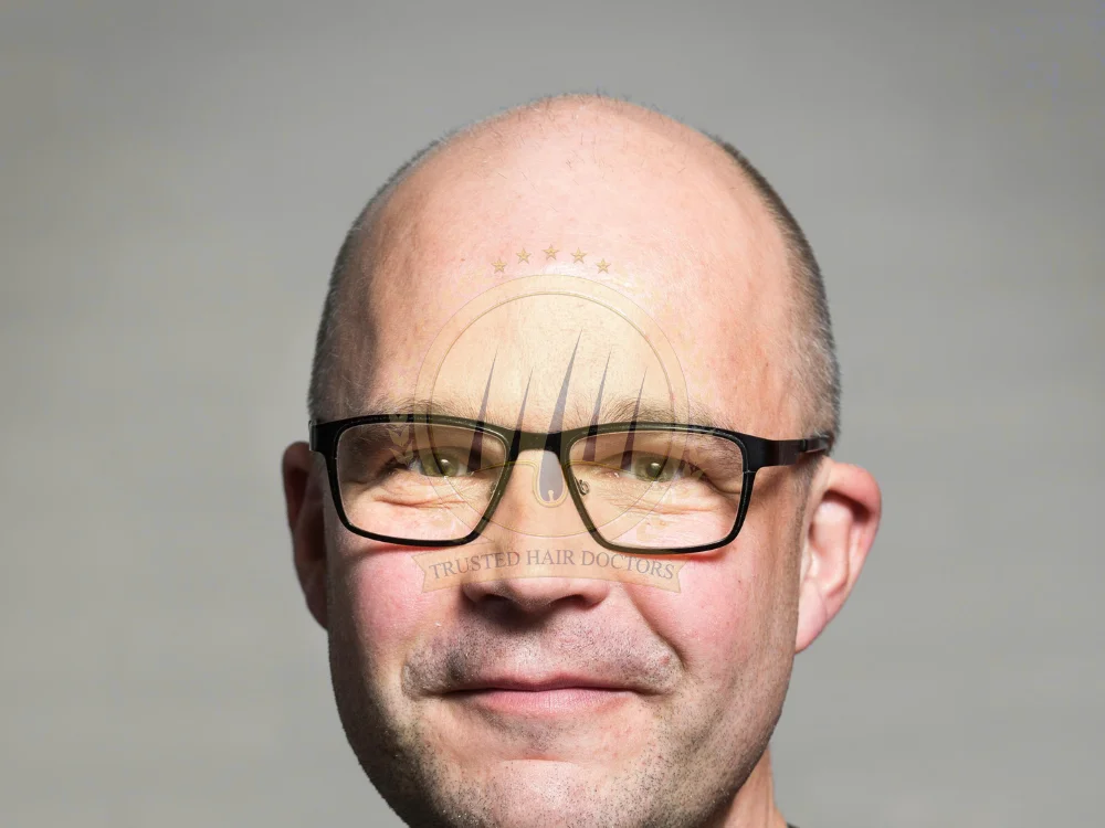 hair-balding-treatment