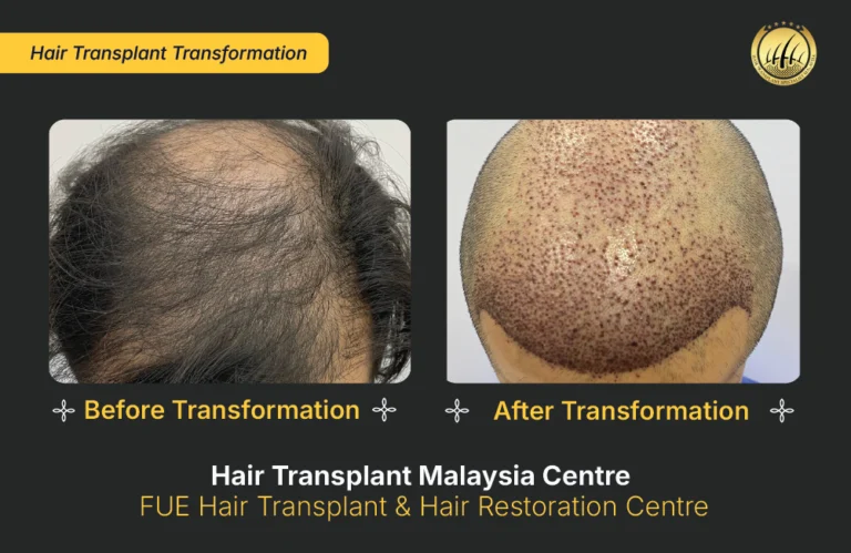 HTM-hair-transplant-malaysia (3)