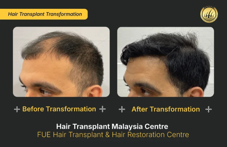 HTM-hair-transplant-malaysia (3)