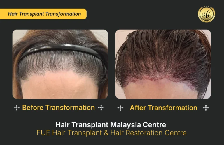 HTM-hair-transplant-malaysia (3)