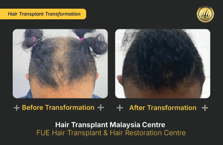HTM-hair-transplant-malaysia (3)