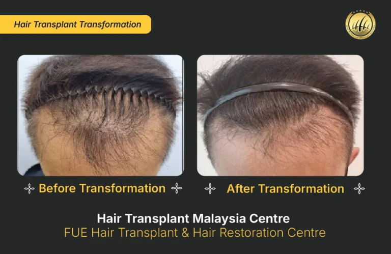 HTM-hair-transplant-malaysia (3)
