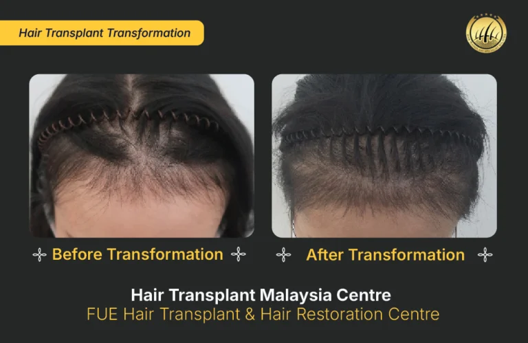 HTM-hair-transplant-malaysia (3)