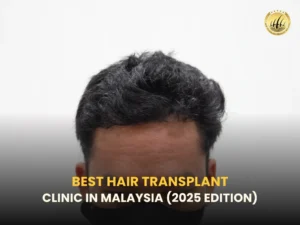 best-hair-transplant