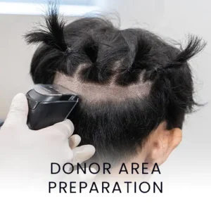 donor-area-hair-surgery-procedure-300x300