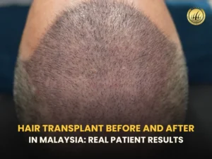 hair-transplant-before-and-after