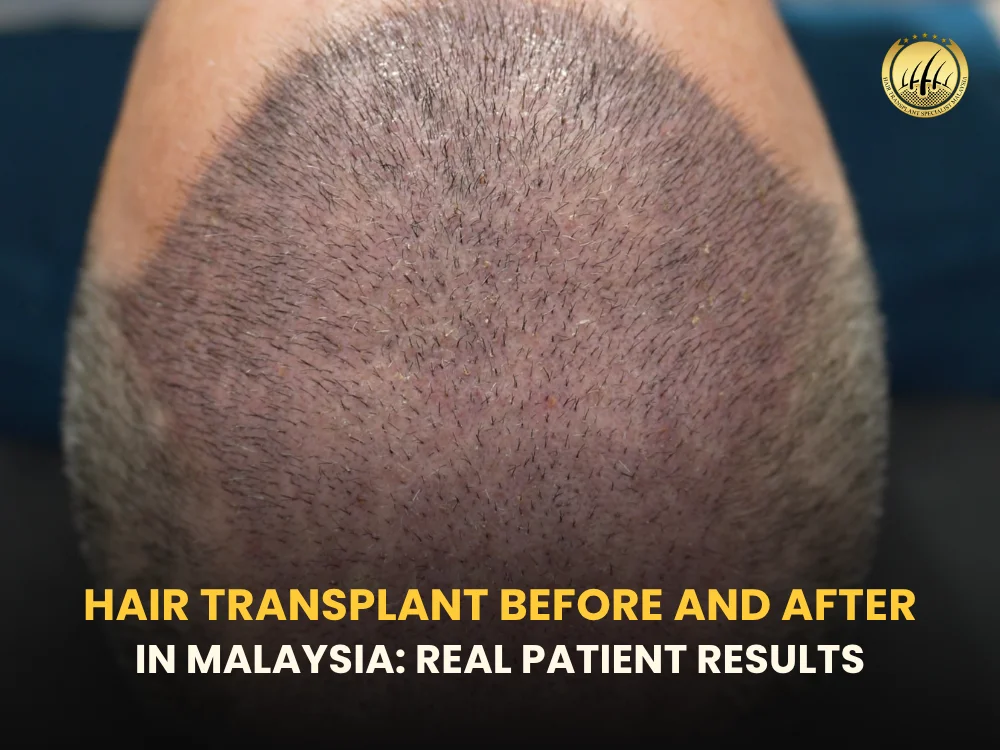 hair-transplant-before-and-after