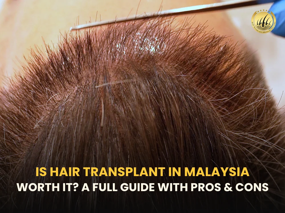 hair-transplant-in-malaysia
