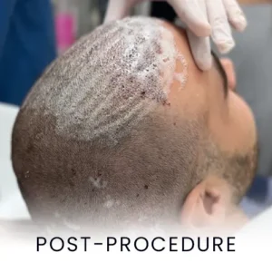 post-procedure-care-hair-surgery-procedure-300x300