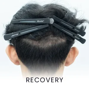 recovery-hair-surgery-procedure-300x300