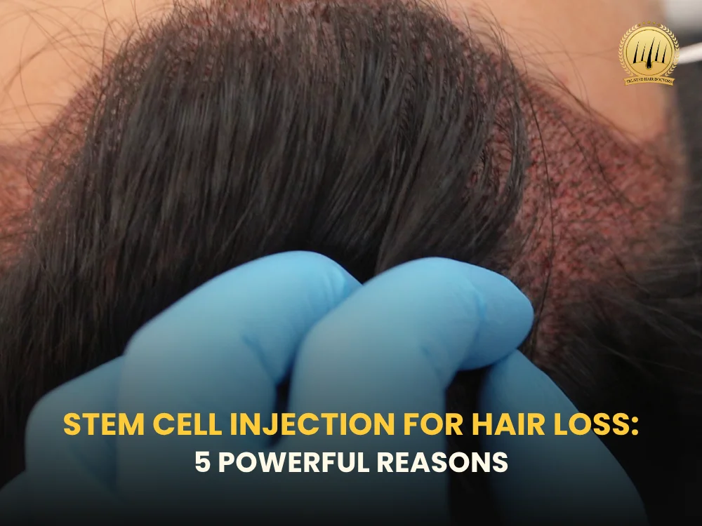 stem-cell-injection-for-hair-loss