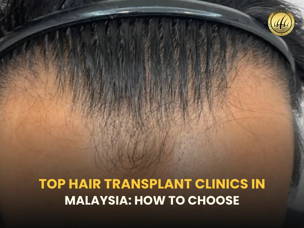 best-hair-transplant-clinics-malaysia