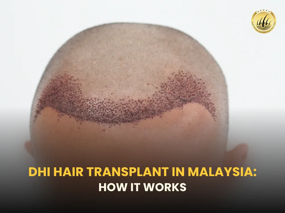 dhi-hair-transplant-malaysia