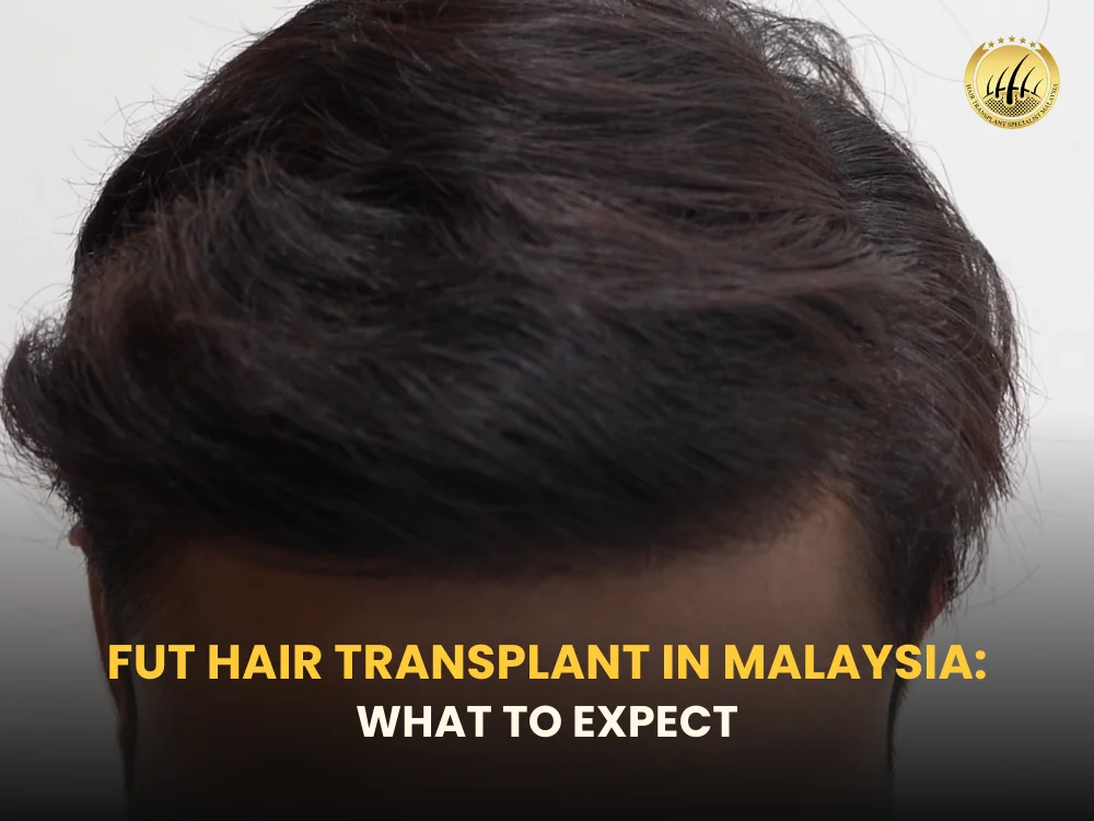 fut-hair-transplant-malaysia