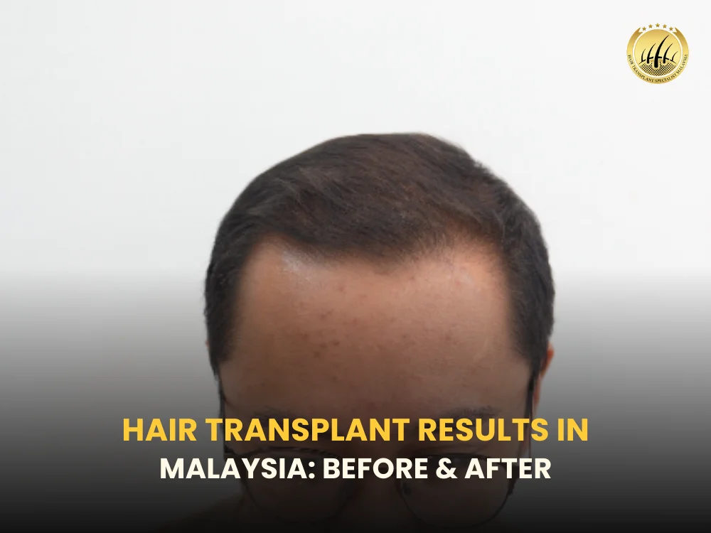 hair-transplant-results-malaysia