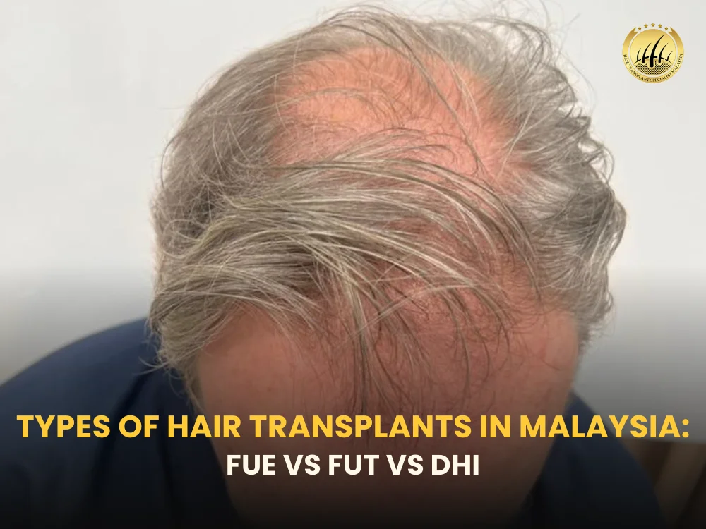 types-of-hair-transplant-malaysia