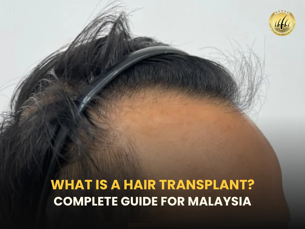 what-is-hair-transplant-malaysia