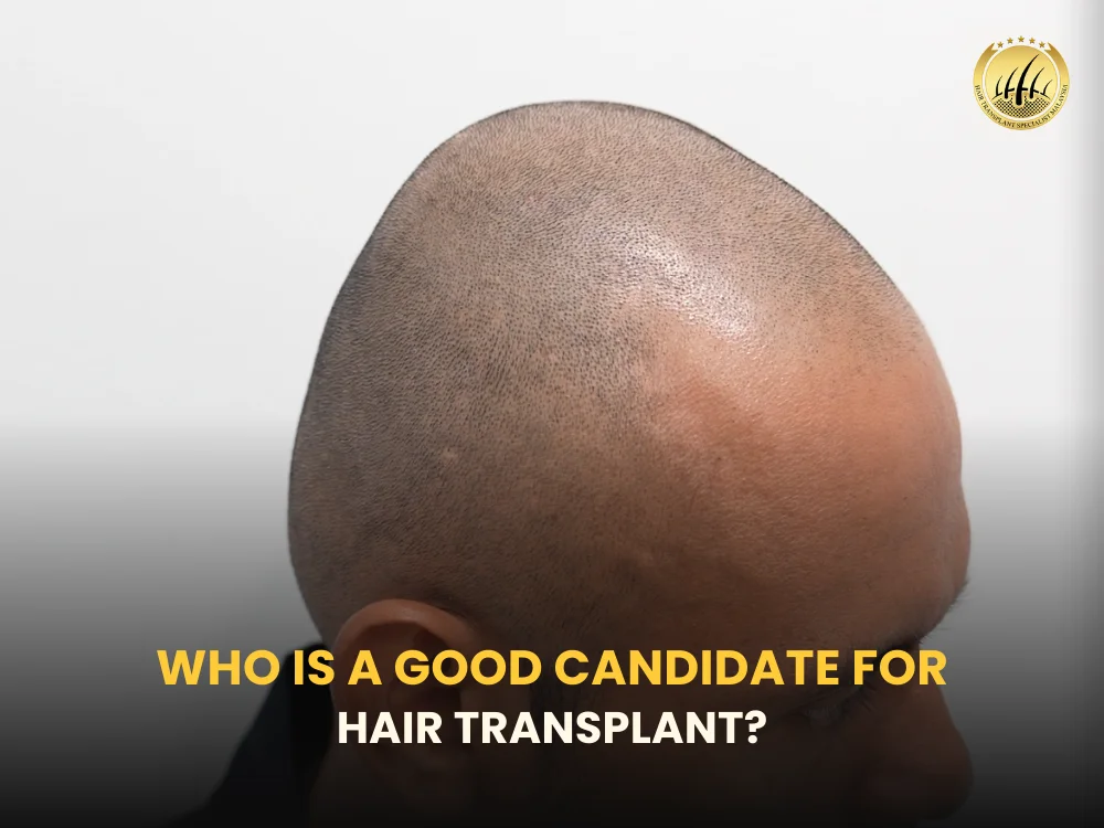 who-is-suitable-for-hair-transplant-malaysia