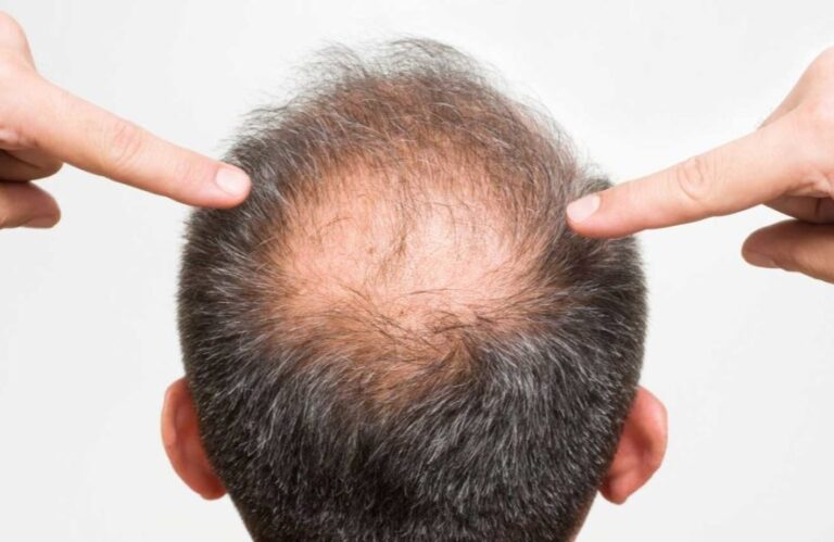 hair transplant malaysia balding