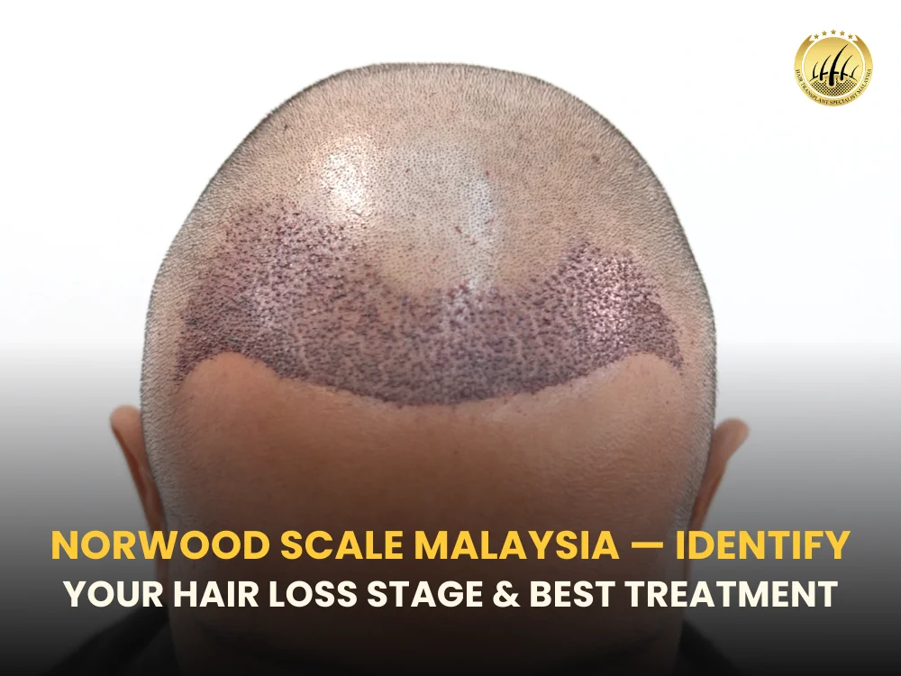 norwood-scale-hair-loss-malaysia
