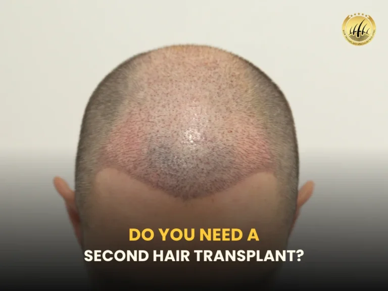 second-hair-transplant