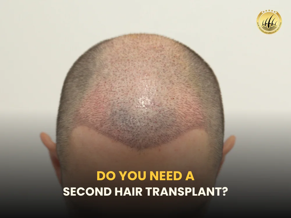 second-hair-transplant