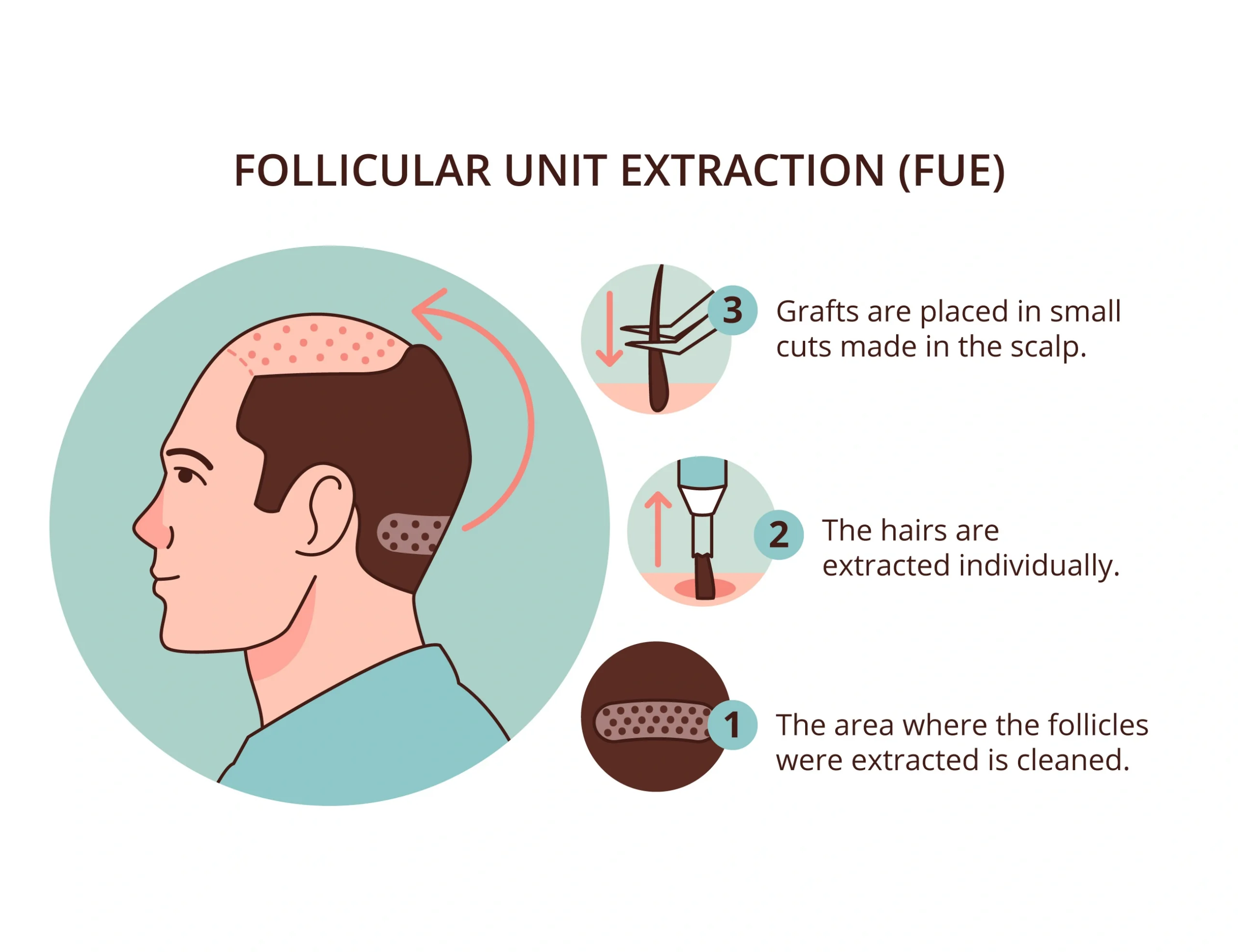 FUE Hair Transplant Procedure