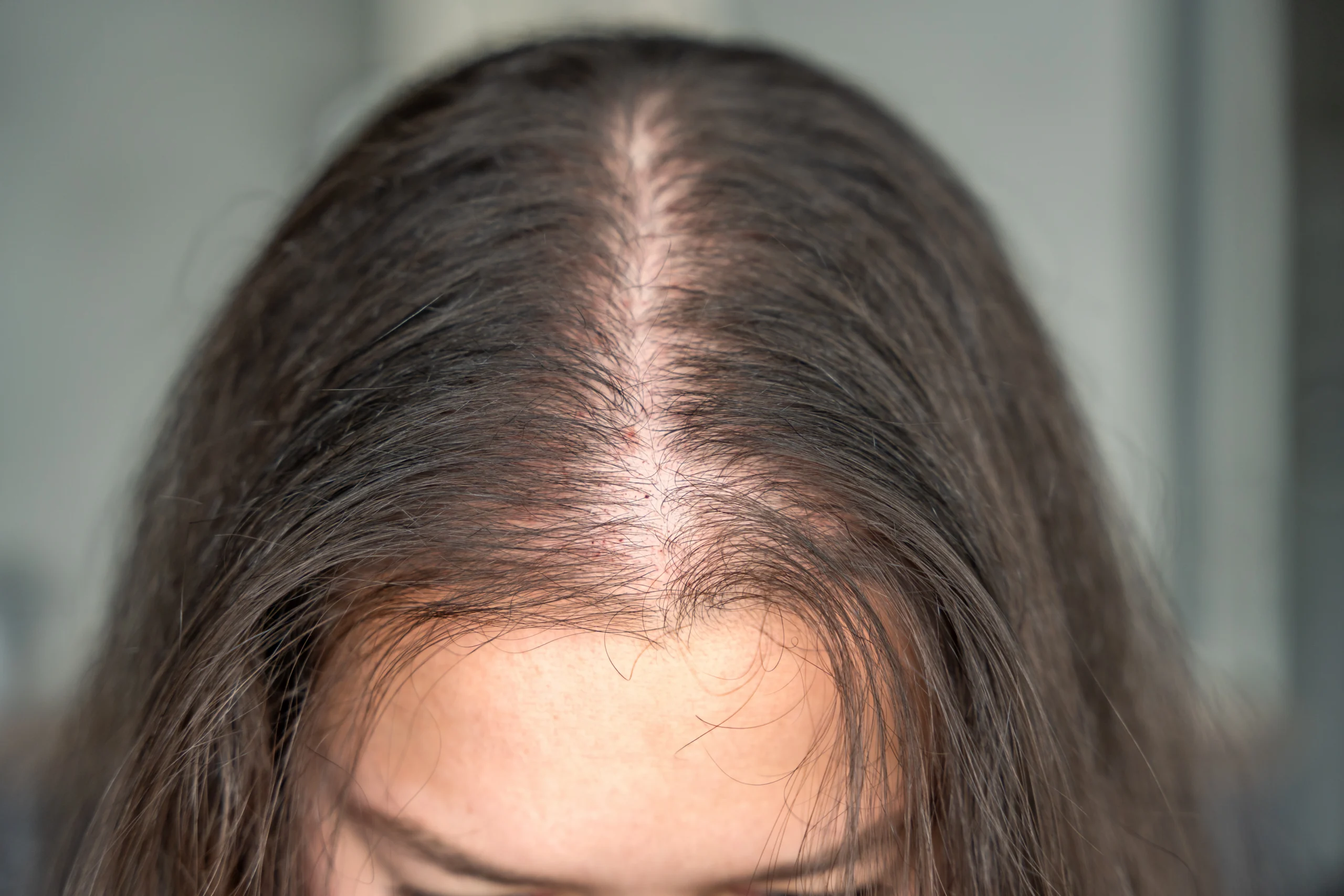 Low hair density