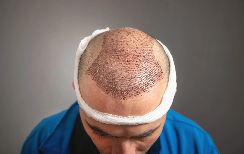 Previous hair transplant correction