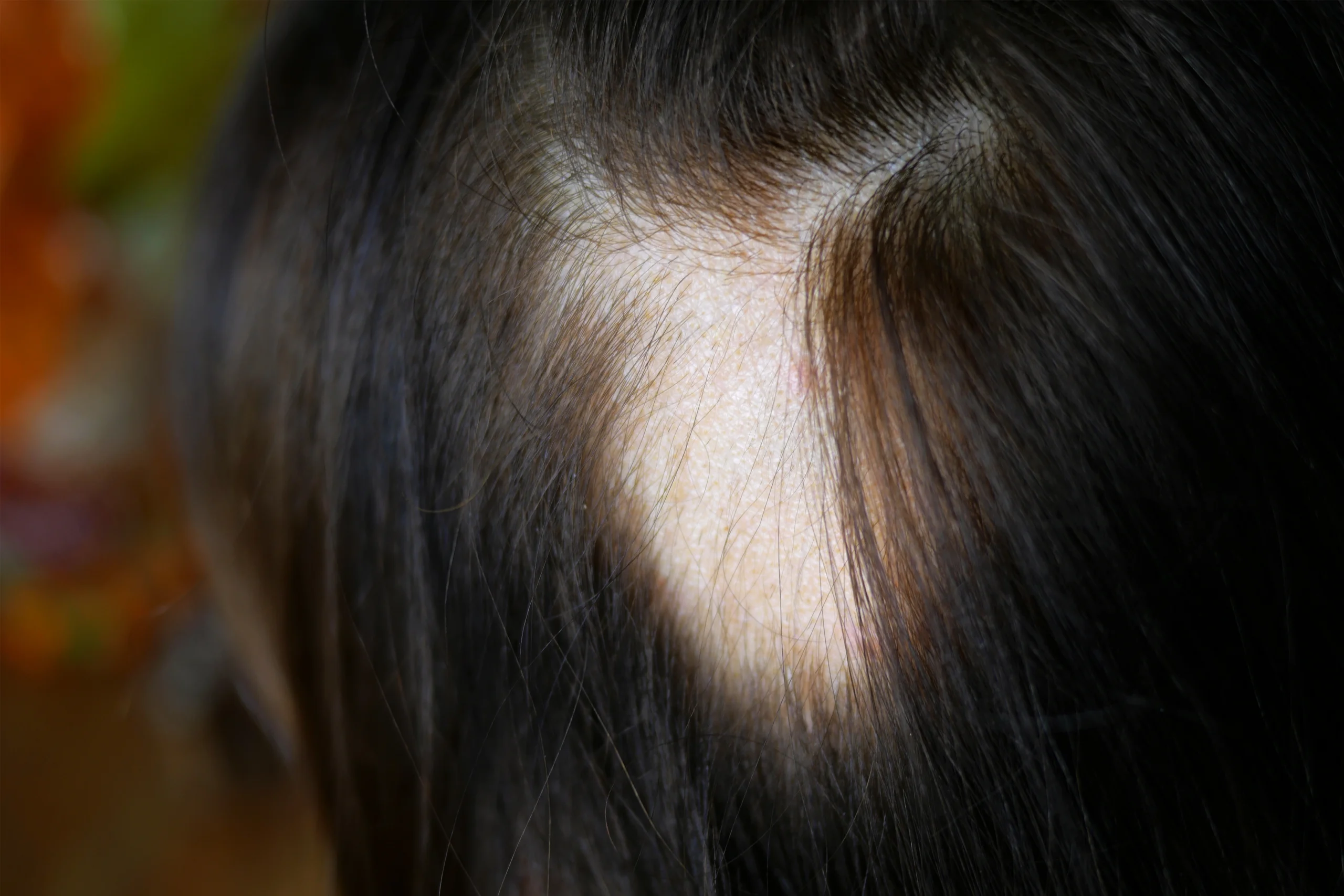 Bald patches