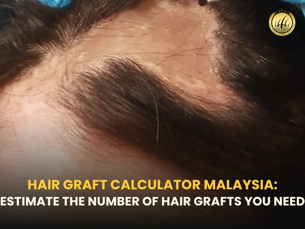 hair-graft-calculator-malaysia