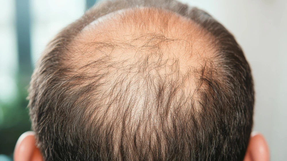 Thinning crown